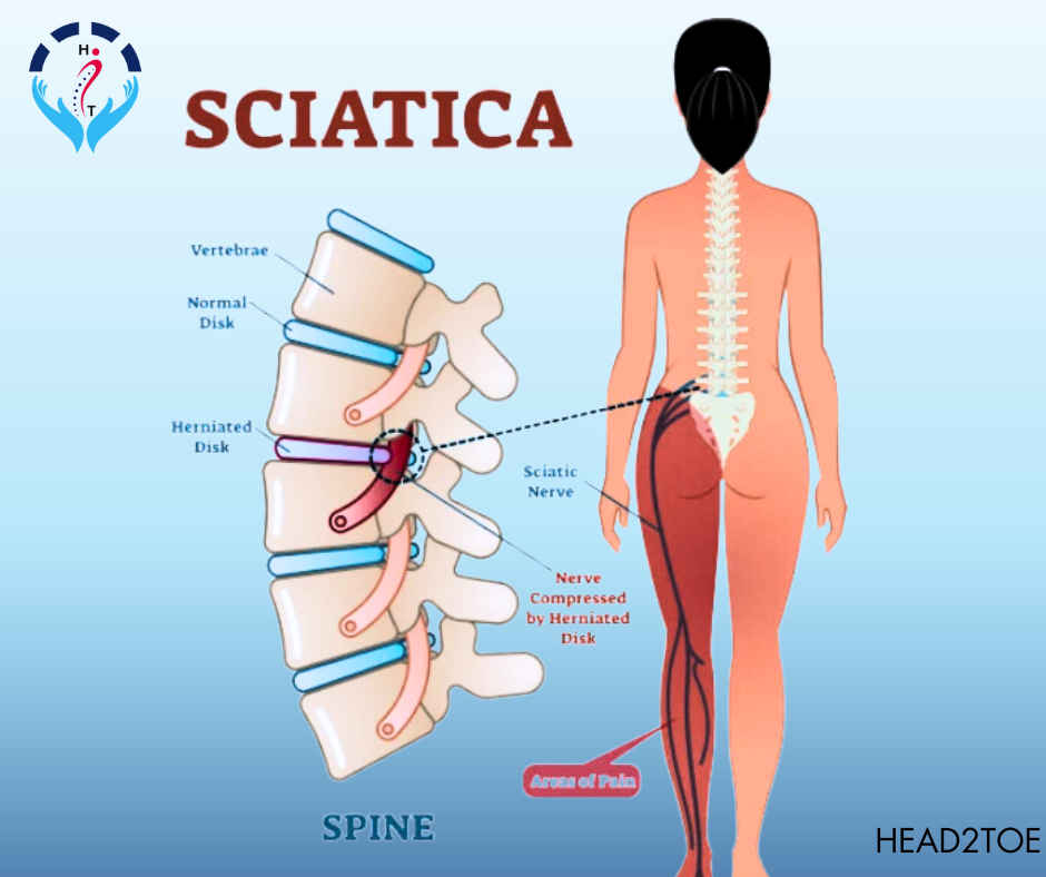 BLOG-SCIATIC-PAIN-1.png